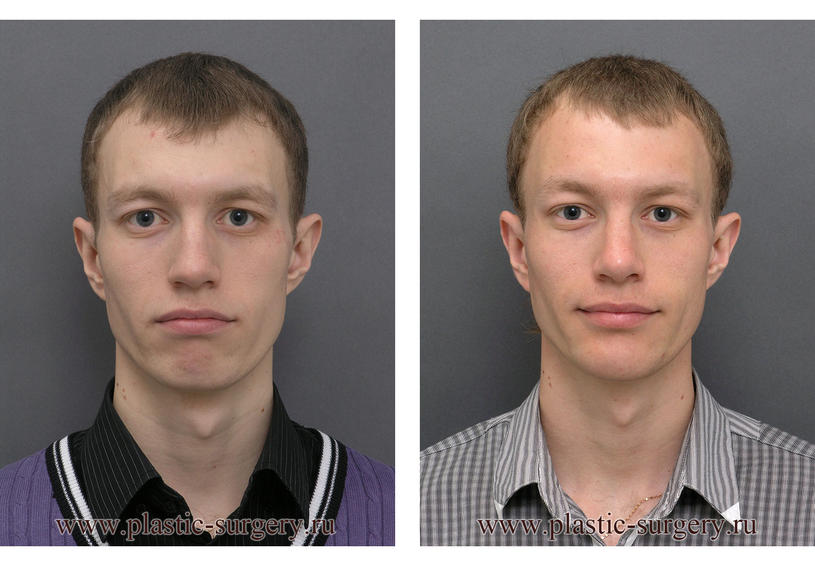 Широкая кость лица. Ринопластика до и после мужчины. Ринопластика носа мужчины до и после.
