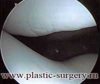 patella dislocation
