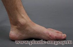 Косточка на большом пальце ноги лечение в екатеринбурге thumbnail