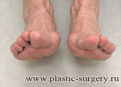 вальгусная деформация пальца стопы