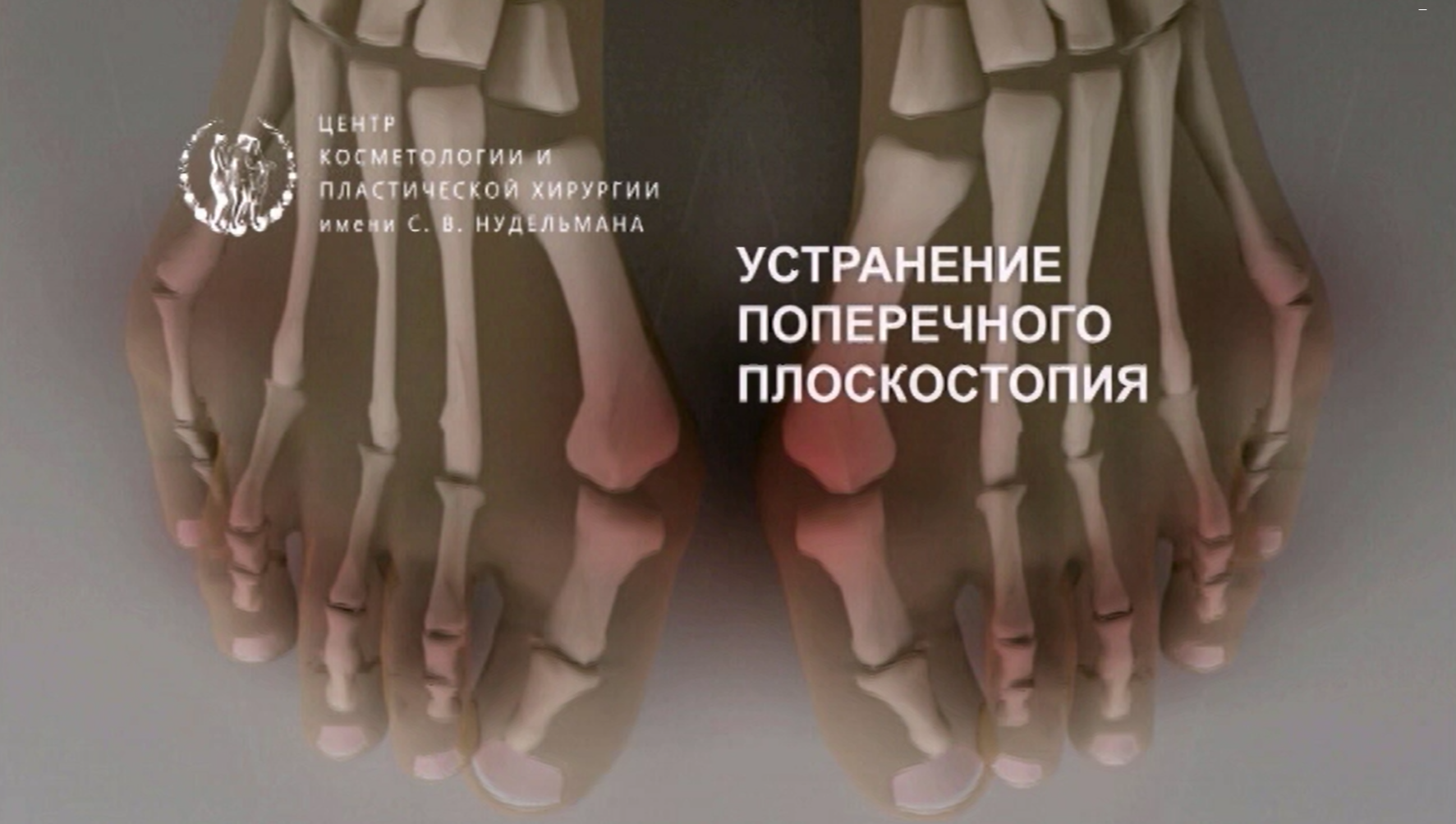 Поперечное плоскостопие