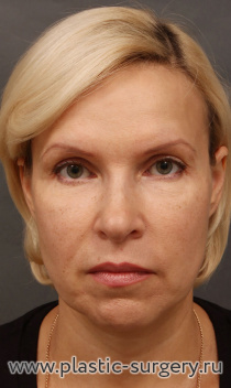 Комплексное омоложение и бьютификация лица и шеи: риносептоластика, увеличение подбородка, липофиллинг подбровных областей, эндоскопический лифтинг лба и височных областей, нижняя пластика век "пинч" методом, булхорн, SMAS-лифтинг нижней трети лица и шеи