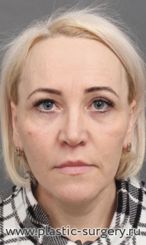 Омоложение лица и шеи: SMAS лифтинг лица и шеи, эндоскопический фронто-темпоральный лифтинг, верхняя и нижняя блефаропластика, медиальная платизмопластика, булхорн, липофилинг верхней и нижней губы. Результат на фото - через год после операции.