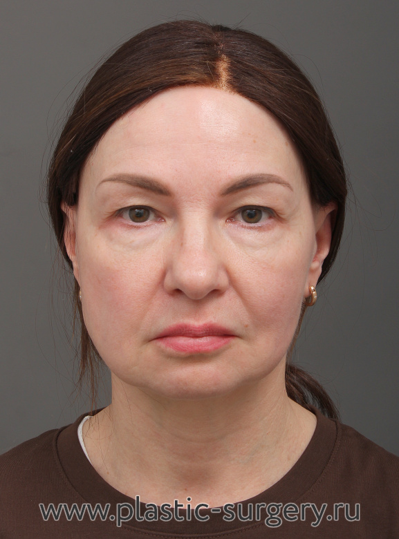 Эндоскопический лифтинг фронтально-темпоральный(лобно-височный). Пластика нижних и верхних век. Результат через 3 месяца после операции - До