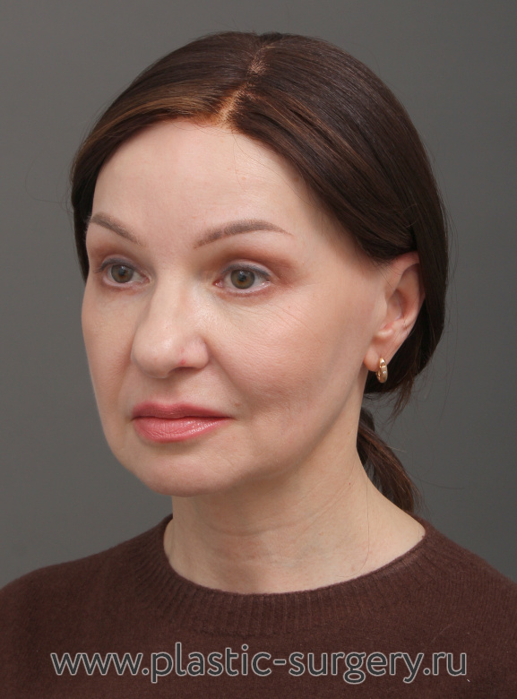 Эндоскопический лифтинг фронтально-темпоральный(лобно-височный). Пластика нижних и верхних век. Результат через 3 месяца после операции - После