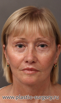Стандартный открытый лифтинг лица и шеи, пластика верхних и нижних век, липофиллинг области носогубных складок, углов рта, красной каймы верхней губы, бровей, коррекция высоты верхней губы.