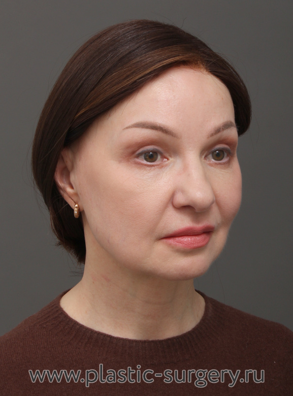 Эндоскопический лифтинг фронтально-темпоральный(лобно-височный). Пластика нижних и верхних век. Результат через 3 месяца после операции - После