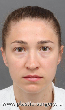 Эндоскопический лифтинг лица. На фото - результат через полгода после операции.