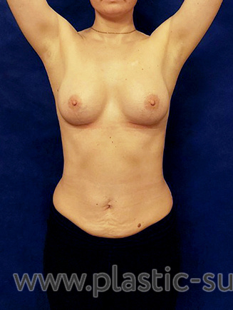 Увеличение молочных желез текстурированными имплантами - После