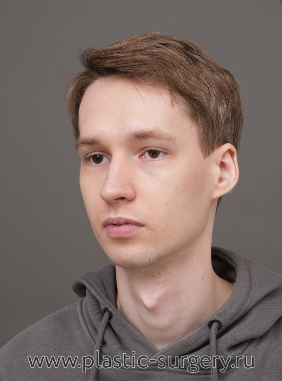 Ментопластика (имплант). Результат через 2 месяца после операции - До