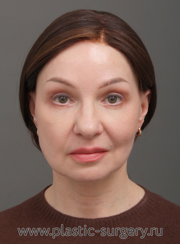 Эндоскопический лифтинг фронтально-темпоральный(лобно-височный). Пластика нижних и верхних век. Результат через 3 месяца после операции - После