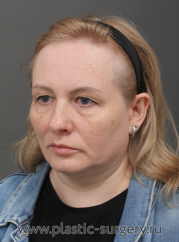 Верхняя блефаропластика. Результат через 3 месяца - До