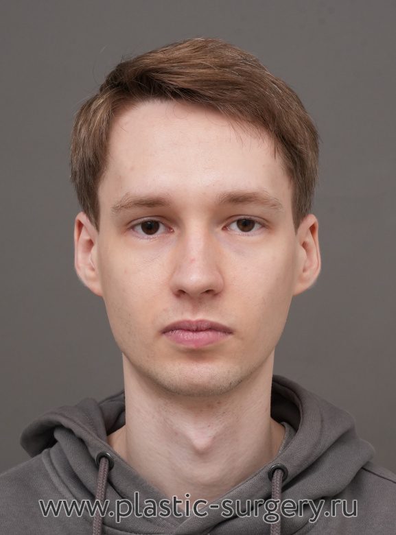 Ментопластика (имплант). Результат через 2 месяца после операции - До