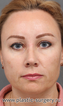 Комплексное эстетическое преображение лица: эндоскопический лифтинг лба и висков, верхняя и нижняя блефаропластика, риносептопластика, липофилинг лица