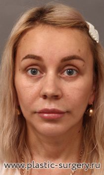 Омоложение лица и шеи: эндоскопия лба, SMAS-лифтинг средней и нижней трети лица и шеи, ментопластика, верхняя и нижняя блефаропластика.