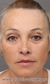 Эндоскопический лобно-височный лифтинг, smas-подтяжка (лифтинг) нижней трети лица и шеи, медиальная и латеральная платизмопластика, коррекция высоты верхней губы (булхорн).