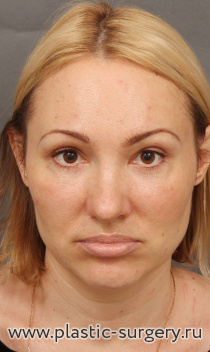 Комплексное омоложение лица: эндоскопический лифтинг лица, транспозиция (перемещение) комков БИША, верхняя и нижняя блефаропластика, увеличение подбородка, липосакция шеи.