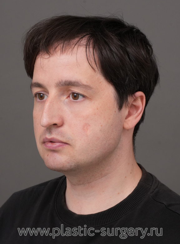 Ментопластика, риносептопластика. Результат через 2 месяца - До
