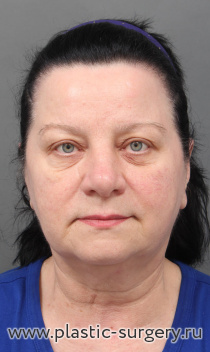 Эндоскопия лба, SMAS лица и шеи, пластика верхних век, пластика нижних век "пинч", липосакция шеи, липофилинг носогубных складок, области бровей, лазерный пилинг лица. Результат - через 4,5 месяца после операции.