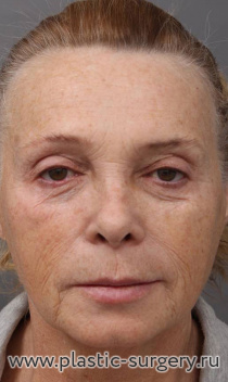 Эндоскопический лобно-височный лифтинг, smas-подтяжка (лифтинг) нижней трети лица и шеи, медиальная и латеральная платизмопластика, коррекция высоты верхней губы (булхорн).