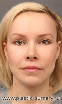 Комплексное омоложение и бьютификация лица и шеи: риносептоластика, увеличение подбородка, липофиллинг подбровных областей, эндоскопический лифтинг лба и височных областей, нижняя пластика век "пинч" методом, булхорн, SMAS-лифтинг нижней трети лица и шеи