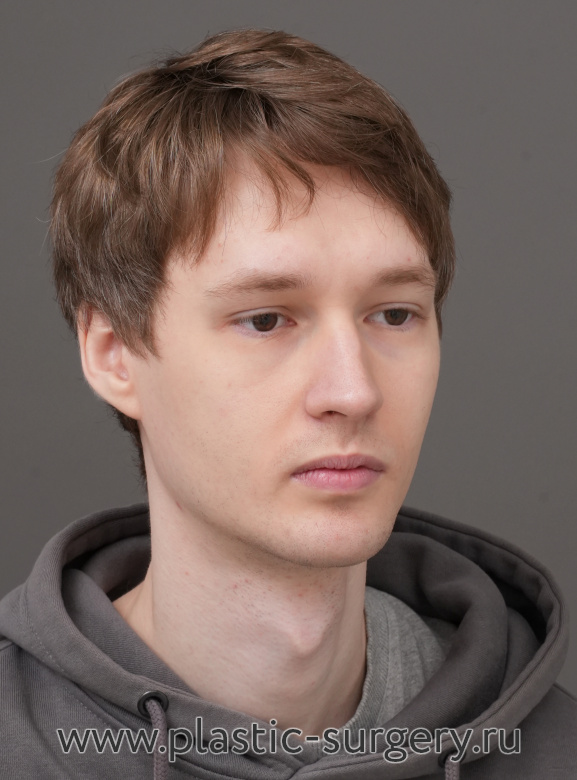 Ментопластика (имплант). Результат через 2 месяца после операции - После