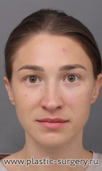 Эндоскопический лифтинг лица. На фото - результат через полгода после операции.