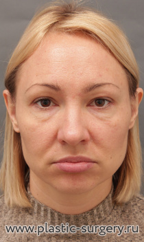 Комплексное омоложение лица: эндоскопический лифтинг лица, транспозиция (перемещение) комков БИША, верхняя и нижняя блефаропластика, увеличение подбородка, липосакция шеи.