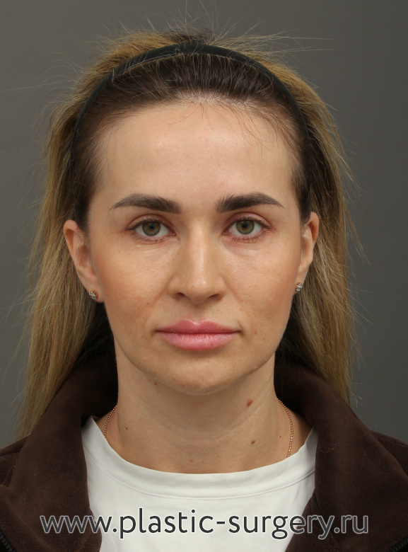 Блефаропластика. Результат через год - После