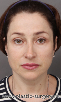 Эндоскопический лобно-височный лифтинг, открытый лифтинг лица и шеи, верхняя блефаропластика, "пинч" нижних век. Результат на фото - через 7 месяцев после операции.