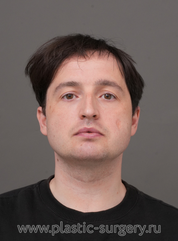 Ментопластика, риносептопластика. Результат через 2 месяца - До