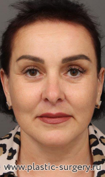 Эндоскопия лба, SMAS лица и шеи, пластика нижних век, медиальная платизмопластика, липосакция подбородка, булхорн, липофилинг бровей, мочки уха 