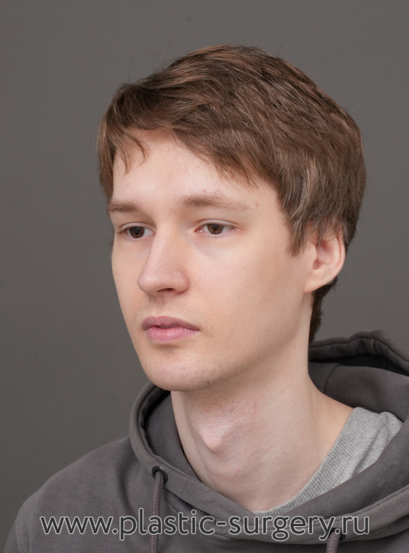 Ментопластика (имплант). Результат через 2 месяца после операции - После
