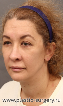 Омоложение лица и шеи: эндоскопия лба, SMAS лица и шеи, верхняя и нижняя блефаропластика, пластика шейной мышцы, ​ липофилинг носогубных складок, липофилинг красной каймы, липофилинг уголков рта, лазерная обработка кожи лица и шеи