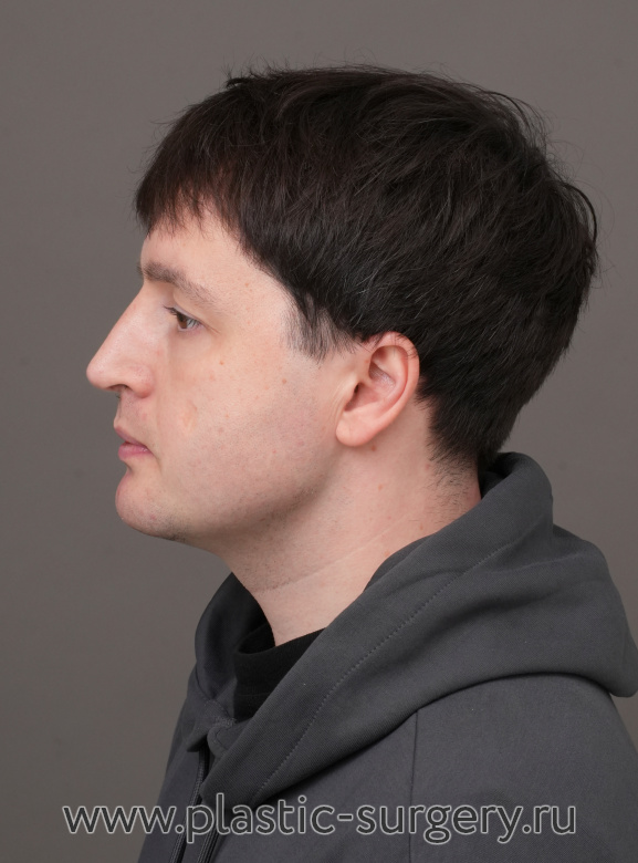 Ментопластика, риносептопластика. Результат через 2 месяца - После