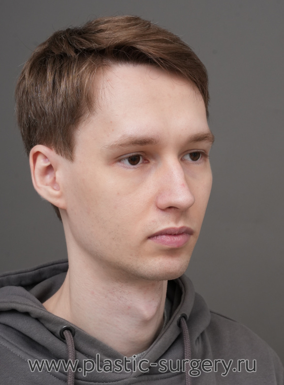 Ментопластика (имплант). Результат через 2 месяца после операции - До