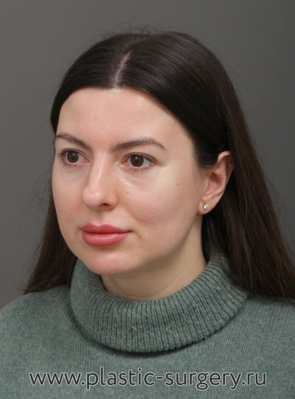 Блефаропластика. Результат через месяц - После