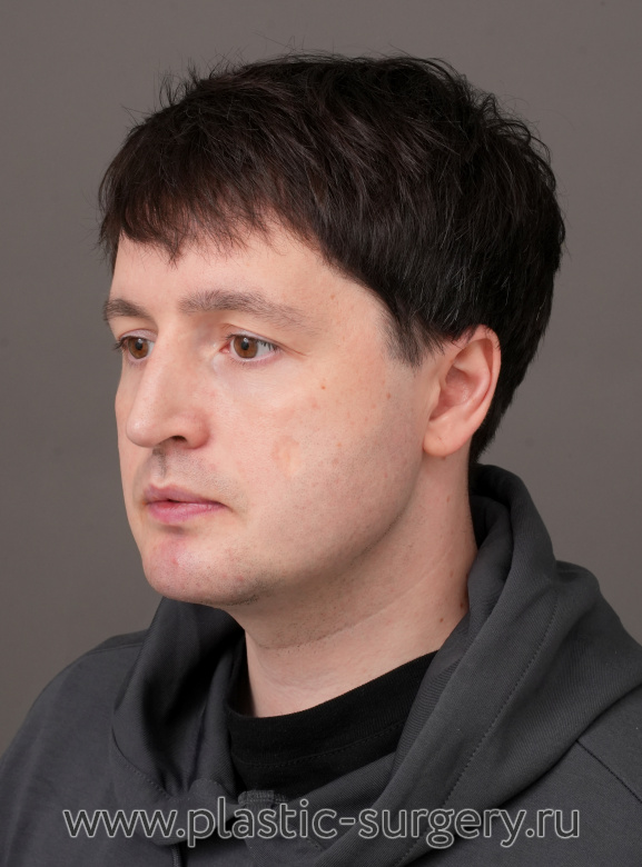 Ментопластика, риносептопластика. Результат через 2 месяца - После