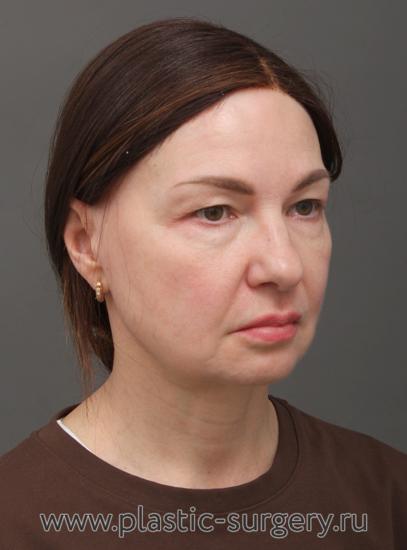 Эндоскопический лифтинг фронтально-темпоральный(лобно-височный). Пластика нижних и верхних век. Результат через 3 месяца после операции - До