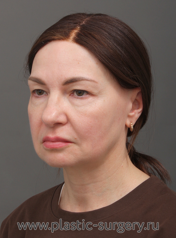 Эндоскопический лифтинг фронтально-темпоральный(лобно-височный). Пластика нижних и верхних век. Результат через 3 месяца после операции - До