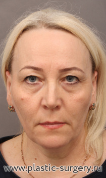 Омоложение лица и шеи: SMAS лифтинг лица и шеи, эндоскопический фронто-темпоральный лифтинг, верхняя и нижняя блефаропластика, медиальная платизмопластика, булхорн, липофилинг верхней и нижней губы. Результат на фото - через год после операции.