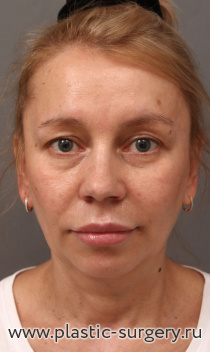 Омоложение лица и шеи: эндоскопия лба, SMAS-лифтинг средней и нижней трети лица и шеи, ментопластика, верхняя и нижняя блефаропластика.