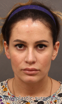 Эндоскопический лифтинг тканей лба и височных областей. Результат - через 1 месяц после операции.