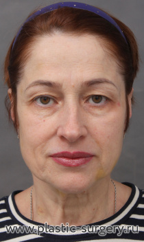 Эндоскопический лобно-височный лифтинг, открытый лифтинг лица и шеи, верхняя блефаропластика, "пинч" нижних век. Результат на фото - через 7 месяцев после операции.