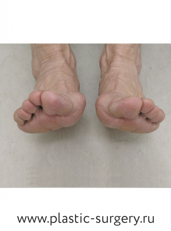 Деформация пальцев стопы мкб. Плоскостопие молоткообразная деформация. Вальгусная деформация плюснефалангового сустава. Вальгусная деформация переднего отдела стопы. Вальгусная деформация 5 пальца.