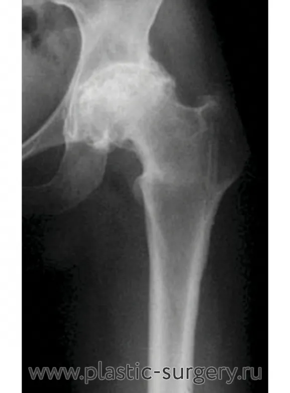 Реабилитация после остеосинтеза плечевой кости - ЛД Медицина - клиника травматологии и ортопедии