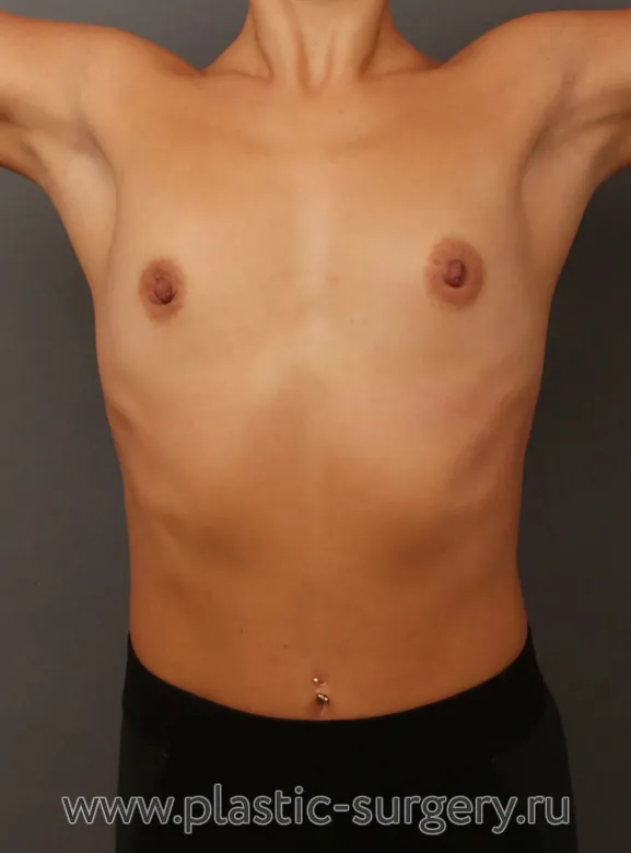 Результат пластической операции - До