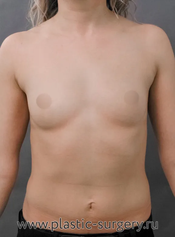 Увеличение маленькой груди - До