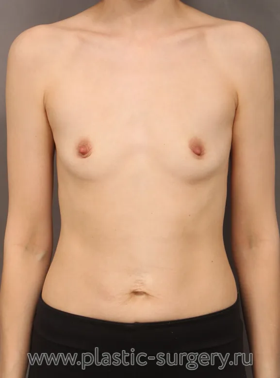 Увеличение груди через подмышку. Трансаксиллярный доступ - До