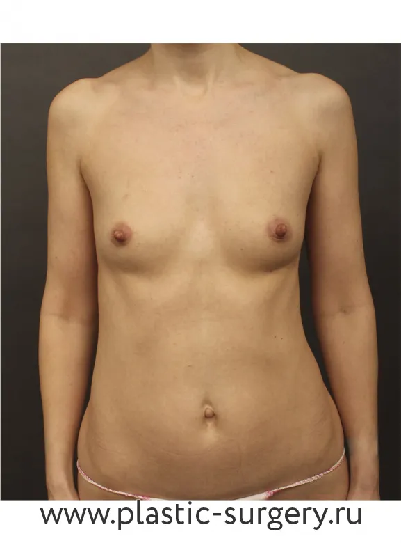 Пластика анатомическими имплантами - До